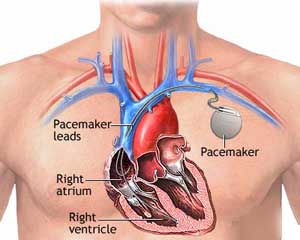 Stimulatoare cardiace